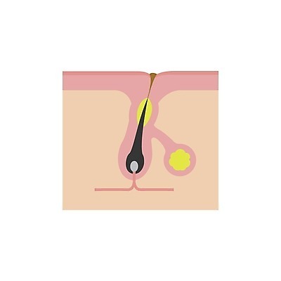 EPS 해외이미지 디자인 신체 일러스트 해부 세포 건강 사람 치료 흰색 질병 피부 생물학 분화구 문제 층 박테리아 끓이기 돌봄 해외일러스트 교육 컬러 의학 모션 신체부위 화산 파일형식 벡터 산 이미지허브
