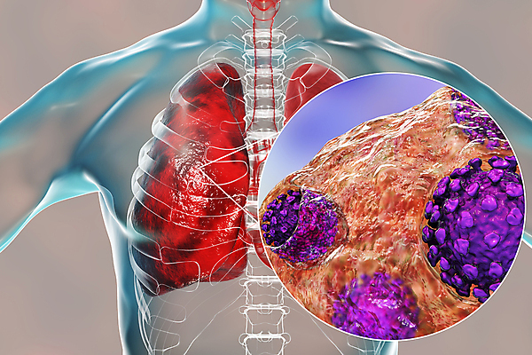 포토 JPG 해외이미지 과학 신체 일러스트 해부 현미경 사람 사람없음 글로벌 약 3D 중국 호흡기관 바이러스 질병 감염 테라피 백신 염증 전염병 해외일러스트 아시아 의학 실험기구 뷰티 장기_의학 디지털합성 파일형식 이미지허브