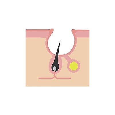 EPS 해외이미지 일러스트 의학 털 건강 사람없음 질병 피부 여드름 피부질환 모공 피부병 피부염 흉터 피부층 해외일러스트 신체부위 상처 파일형식 벡터 이미지허브