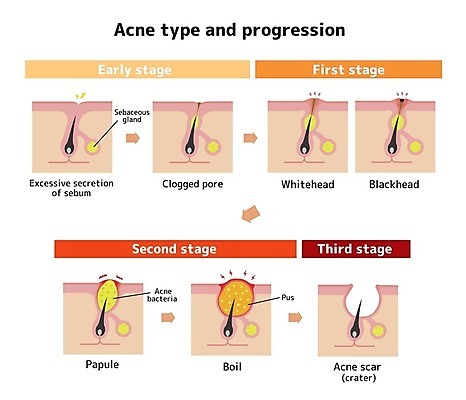 EPS 해외이미지 화살표 일러스트 의학 털 건강 사람없음 질병 피부 단계 여드름 피부질환 모공 피부병 피부염 피부트러블 피부층 해외일러스트 신체부위 파일형식 벡터 이미지허브