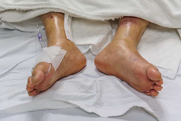 포토 JPG 해외이미지 컨셉 건강 병원 사람 성인 사람없음 치료 약 고통 환자 간호사 긴급 액체 주름 수술 질병 감염 튜브 발가락 주사약 암 외과 정맥 돌봄 복용 양발 제어 조부모 지원 치유 투입 헬프 해외포토 감정 의학 가족 모션 발 의료진 도움 혈관 파일형식 이미지허브