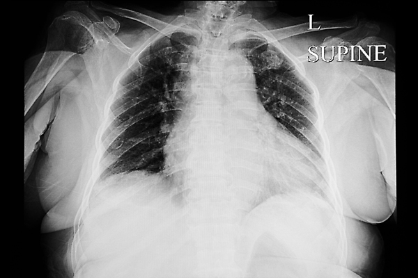 포토 JPG 해외이미지 신체 해부 뼈 골격 엑스레이 건강 병원 사람 사람없음 약 환자 광선 흰색 하트 허파 호흡기관 질병 X 흉부 필름 펌프 궤 돌봄 방사선 해외포토 모양 알파벳 컬러 의학 모션 장기_의학 파일형식 이미지허브
