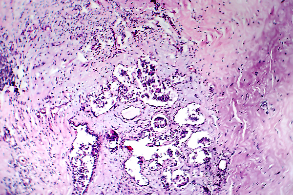 포토 JPG 해외이미지 여자 현미경 사람없음 약 얼룩 조직 변화 확대 질병 가슴 종양 해외포토 컨셉 의학 실험기구 사람 신체부위 파일형식 이미지허브