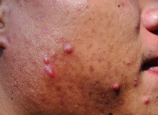 포토 JPG 해외이미지 백인 여자 남자 얼굴 신체 건강 사람 소년 사람없음 10대 빨간색 머리 지성 짜증 폭발 피부 질감 감염 문제 턱 여드름 알레르기 나쁜 돌봄 사춘기 위생관리 못생김 해외포토 서양인 감정 어린이 컬러 모션 청소년 관리 신체부위 질병 파일형식 이미지허브