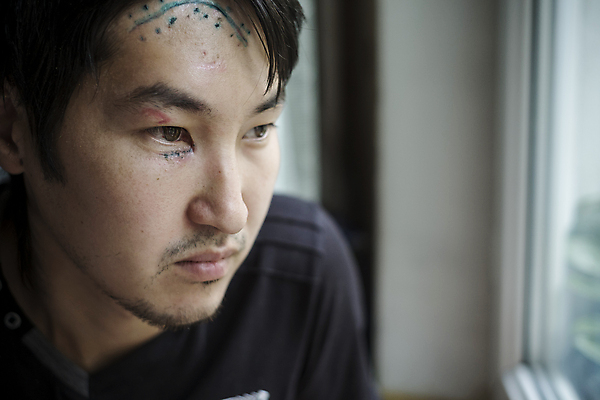 포토 JPG 해외이미지 1 남자 얼굴 한명 사람 동양인 성인 가로 약 머리 환자 상처 눈썹 피부 이마 진짜 흉터 해외포토 의학 인종 신체부위 파일형식 이미지허브