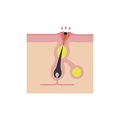 EPS 해외이미지 일러스트 의학 털 건강 사람없음 질병 피부 피부질환 모공 피부트러블 피지 블랙헤드 피부층 해외일러스트 신체부위 파일형식 벡터 이미지허브