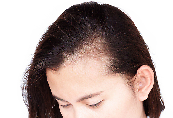 포토 JPG 해외이미지 여자 건강 한명 성인 치료 머리 머리빗 걱정 돌봄 탈모 성인여자한명만 해외포토 1 감정 의학 모션 사람 신체부위 미용용품 증상 여자한명만 성인여자만 파일형식 이미지허브