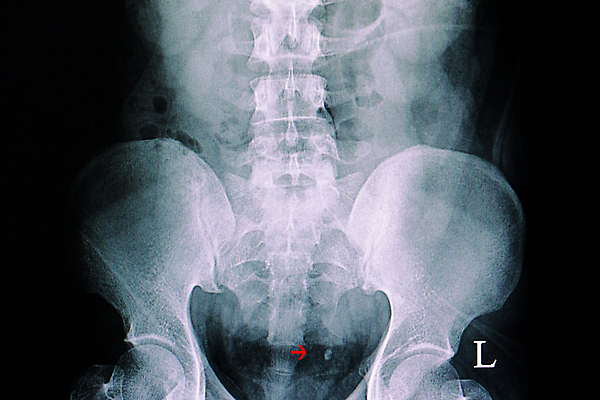 포토 JPG 해외이미지 백그라운드 신체 해부 뼈 골격 엑스레이 병원 사람 사람없음 약 검은색 환자 광선 흰색 신장 질병 X 필름 외과 방광 돌봄 방사선 해외포토 알파벳 컬러 의학 모션 비뇨기관 파일형식 이미지허브