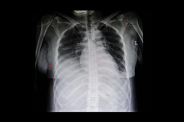 포토 JPG 해외이미지 선 백그라운드 신체 해부 뼈 골격 엑스레이 건강 병원 사람없음 약 고통 환자 광선 흰색 호흡기관 질병 X 흉부 필름 감염 궤 돌봄 방사선 심각 해외포토 알파벳 감정 컬러 컨셉 의학 모션 장기_의학 파일형식 이미지허브