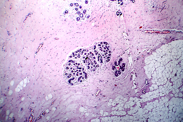 포토 JPG 해외이미지 여자 현미경 사람없음 약 얼룩 조직 확대 질병 가슴 암 종양 해외포토 의학 실험기구 사람 신체부위 파일형식 이미지허브