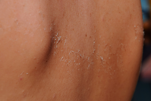 포토 JPG 해외이미지 손 여자 신체 휴가 건강 사람없음 치료 빨간색 태양 광선 선탠 보호 질병 상처 위험 버리기 피부 어깨 알레르기 감탄 곰팡이 방사선 염증 오존 화상 효과 해외포토 자연요소 컬러 컨셉 의학 모션 사람 신체부위 파일형식 이미지허브