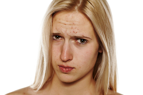 포토 JPG 해외이미지 학생 여자 얼굴 청소년 한명 10대 금발 약 짜증 점 찡그림 피부 흰배경 감염 문제 여드름 돌봄 사춘기 이마 못생김 해외포토 1 헤어스타일 감정 백그라운드 의학 모션 표정 사람 신체부위 흰색 파일형식 이미지허브