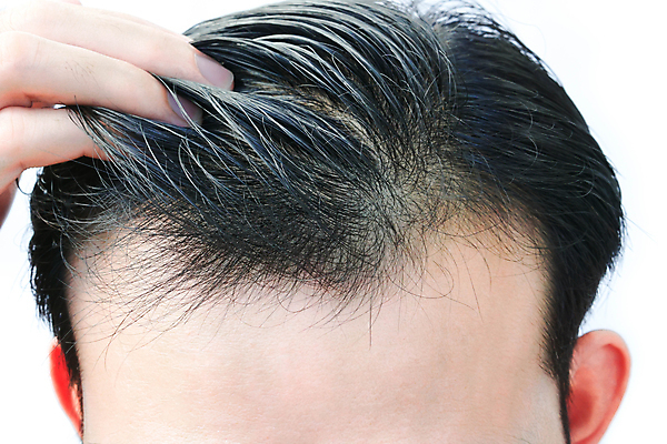 포토 JPG 해외이미지 헤어스타일 응시 남자 백그라운드 컨셉 건강 한명 사람 성인 치료 뷰티 머리 성장 흰색 머리빗 걱정 가발 대머리 문제 샴푸 돌봄 스타일리스트 얇은 옛날 적자 헬프 해외포토 1 시선 감정 컬러 의학 모션 신체부위 위생용품 미용용품 도움 파일형식 이미지허브