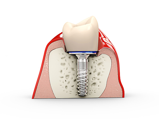 포토 JPG 해외이미지 아이콘 디자인 백그라운드 왕관 뼈 건강 치과 병원 사람 사람없음 치료 세트 장비 흰색 나사 입 구멍 치아 치과의사 뿌리 문제 턱 틀니 고립 골절 돌봄 보철 썩음 철강 치아교정 항생제 해외포토 컬러 의학 모션 신체부위 약 의사 공구 소화기관 교정 파일형식 이미지허브