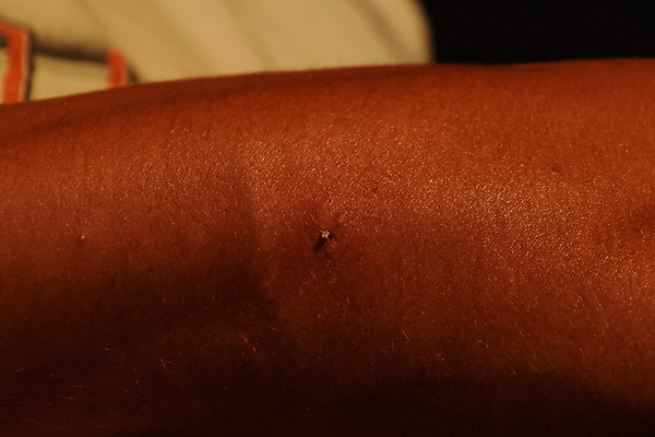 포토 JPG 해외이미지 동물 손 곤충 백그라운드 프레임 사람 사람없음 야외 치료 빨간색 약 고통 점 독약 꿀벌 말벌 상처 위험 공격 벌 가득함 피부 펜촉 충격 주사약 꿀 테라피 찌르기 토막 알레르기 반응 양봉 에이즈 해외포토 감정 컬러 컨셉 의학 모션 신체부위 뷰티 펜 벌_곤충 질병 파일형식 이미지허브