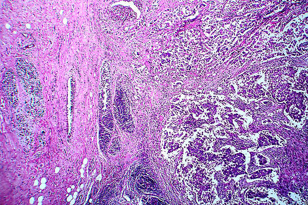 포토 JPG 해외이미지 여자 현미경 사람없음 약 얼룩 조직 변화 확대 질병 가슴 암 종양 해외포토 컨셉 의학 실험기구 사람 신체부위 파일형식 이미지허브