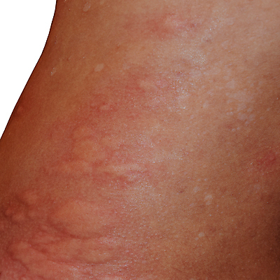 포토 JPG 해외이미지 곤충 표면 건강 육류 사람 사람없음 빨간색 약 고통 환자 짜증 원형 거친 닫기 질병 상처 위험 무서움 피부 크림 묘사 어깨 목 문제 보여주기 찌르기 알레르기 두드러기 돌봄 반응 염증 주목 증상 해외포토 도형 동물 감정 컬러 컨셉 식재료 의학 모션 신체부위 파일형식 이미지허브