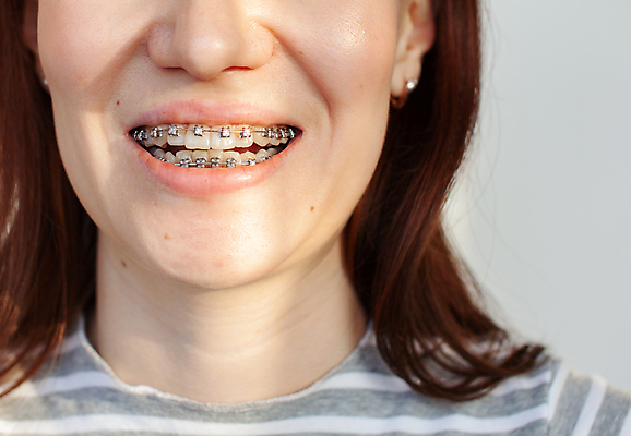 포토 JPG 해외이미지 여자 치과 한명 미소 성인 치아 교정기 위생관리 치아건강 치아교정 성인여자한명만 해외포토 1 표정 건강 병원 관리 사람 소화기관 교정 여자한명만 성인여자만 파일형식 이미지허브