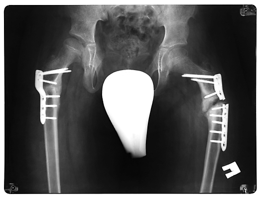 포토 JPG 해외이미지 신체 해부 뼈 엑스레이 건강 병원 사람 사람없음 약 공백 의사 광선 X 엉덩이 사건 필름 무릎 깨짐 방사선 해외포토 알파벳 컨셉 의학 신체부위 의료진 파일형식 이미지허브