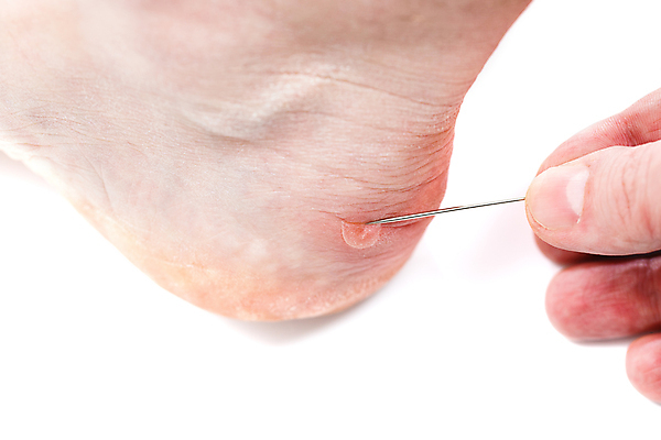 포토 JPG 해외이미지 백인 손 스포츠 신체 새로움 부츠 건강 옥수수 성인 사람없음 치료 고통 흰색 신선 액체 상처 작음 피부 부드러움 문제 해결 방광 파열 순서 벌거벗은 양발 팝 살균 해외포토 서양인 감정 컬러 신발 컨셉 의학 곡류 사람 신체부위 감각 비뇨기관 크기 파일형식 이미지허브