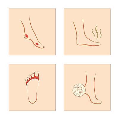 EPS 해외이미지 여자 일러스트 발 건조 사람 고통 균열 지저분함 질병 상처 피부 냄새 감염 문제 발가락 악취 고립 곰팡이 당뇨병 돌봄 양발 해외일러스트 감정 의학 모션 신체부위 감각 파일형식 벡터 이미지허브