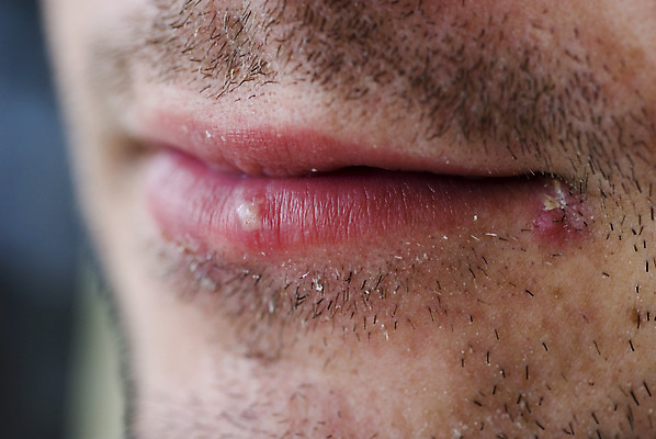 포토 JPG 해외이미지 얼굴 사람없음 입 질병 피부 입술 감염 문제 불평 해외포토 의학 신체부위 파일형식 이미지허브