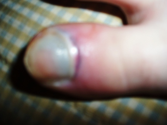 포토 JPG 해외이미지 발 뼈 건강 사람없음 치료 빨간색 보라색 고통 못 상처 사건 피부 문제 발가락 골절 깨짐 단절 돌봄 벌거벗은 양발 노화 해외포토 감정 컬러 컨셉 의학 모션 신체부위 공구 파일형식 이미지허브