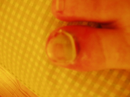 포토 JPG 해외이미지 발 뼈 건강 사람없음 치료 빨간색 보라색 고통 못 상처 사건 피부 문제 발가락 골절 깨짐 단절 돌봄 벌거벗은 양발 노화 해외포토 감정 컬러 컨셉 의학 모션 신체부위 공구 파일형식 이미지허브