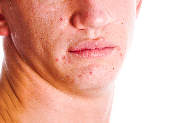 포토 JPG 해외이미지 백인 1 남자 얼굴 백그라운드 부분 스트레스 건강 한명 소년 성인 치료 10대 약 머리 슬픔 짜증 흰색 점 피부 고민 문제 턱 불만 여드름 고립 사춘기 심각 염증 우울증 유일 해외포토 서양인 감정 어린이 컬러 컨셉 의학 청소년 사람 신체부위 질병 파일형식 이미지허브