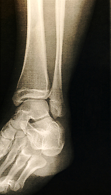 포토 JPG 해외이미지 신체 해부 뼈 골격 엑스레이 사람 사람없음 발목 방사선 양발 해외포토 의학 발 파일형식 이미지허브