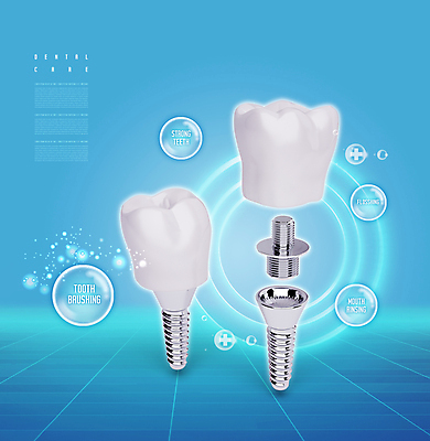 PSD 편집이미지 치과 사람없음 파란색 치아 치아모형 나사못 임플란트 치아건강 이미지편집 컬러 건강 병원 못 소화기관 파일형식