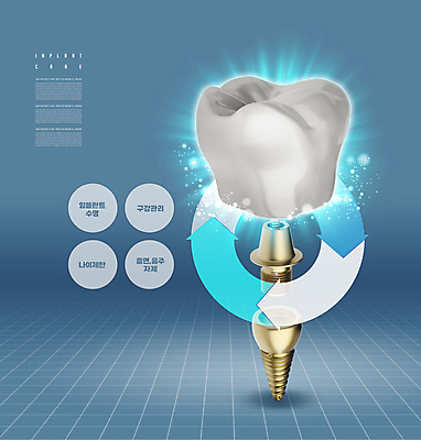 PSD 편집이미지 화살표 그래프 치과 사람없음 파란색 빛 치아모형 나사못 임플란트 치아건강 이미지편집 컬러 건강 병원 못 치아 파일형식