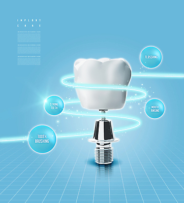PSD 편집이미지 하늘색 치과 사람없음 빛 치아 치아모형 나사못 임플란트 치아건강 이미지편집 건강 병원 파란색 못 소화기관 파일형식