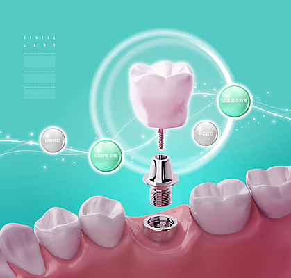 PSD 편집이미지 치과 사람없음 빛 치아 치아모형 나사못 민트색 임플란트 잇몸 치아건강 이미지편집 컬러 신체 건강 병원 못 소화기관 파일형식