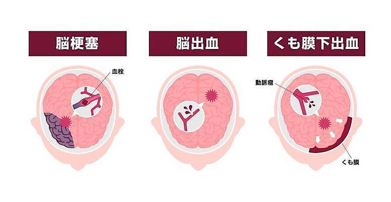 EPS 해외이미지 화살표 말풍선 일러스트 의학 건강 사람없음 혈액 질병 뇌 혈관 뇌졸중 뇌질환 뇌출혈 해외일러스트 장기_의학 파일형식 벡터 이미지허브