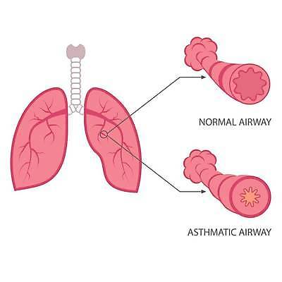EPS 해외이미지 과학 백그라운드 일러스트 해부 건강 사람 그래픽 세계 약 흰색 오르간 호흡기관 질병 공격 시스템 알레르기 고립 돌봄 해외일러스트 컬러 의학 모션 장기_의학 건반악기 파일형식 벡터 이미지허브