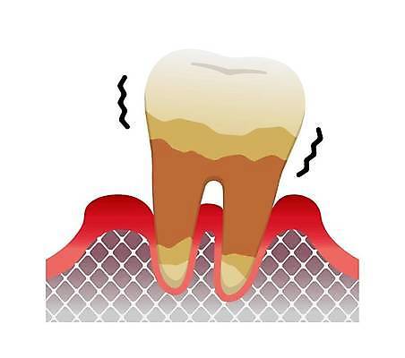 EPS 해외이미지 일러스트 의학 사람없음 치아 지저분함 질병 흔들림 염증 잇몸 치아건강 무너짐 해외일러스트 신체 모션 건강 소화기관 감각 파일형식 벡터 이미지허브
