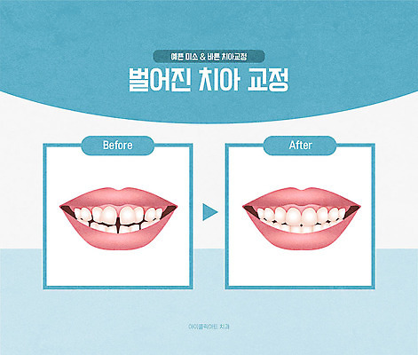 일러스트 치과 신체부위 파란색 뷰티 입 치아 교정 시술 치과진료 치아교정 국내일러스트 AI파일 컬러 병원 사람 진료 소화기관 파일형식 벡터