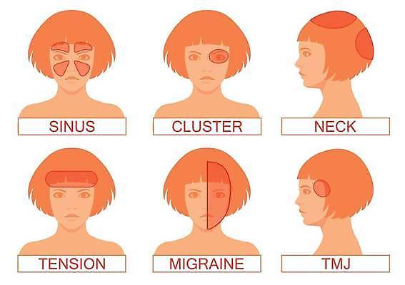 EPS 해외이미지 얼굴 신체 일러스트 부분 스트레스 건강 병원 종류 약 머리 고통 환자 의사 질병 만화 뇌 두통 지역 포인트 긴장 타입 편두통 해외일러스트 감정 의학 신체부위 금융 의료진 파일형식 벡터 이미지허브