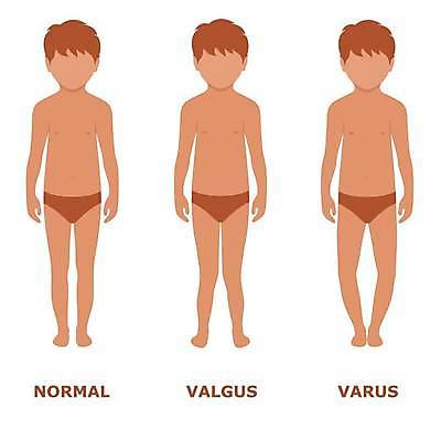 EPS 해외이미지 어린이 신체 일러스트 해부 발 뼈 건강 사람 약 고통 플랫 질병 심볼 아치 관절염 무릎 외과 타입 발목 돌봄 양발 정형외과 해외일러스트 감정 의학 모션 병원 신체부위 파일형식 벡터 이미지허브