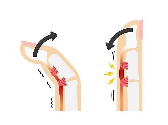 EPS 해외이미지 화살표 일러스트 의학 근육 건강 사람없음 고통 검지손가락 구부림 질병 손가락뼈 해외일러스트 감정 손가락 모션 파일형식 벡터 이미지허브