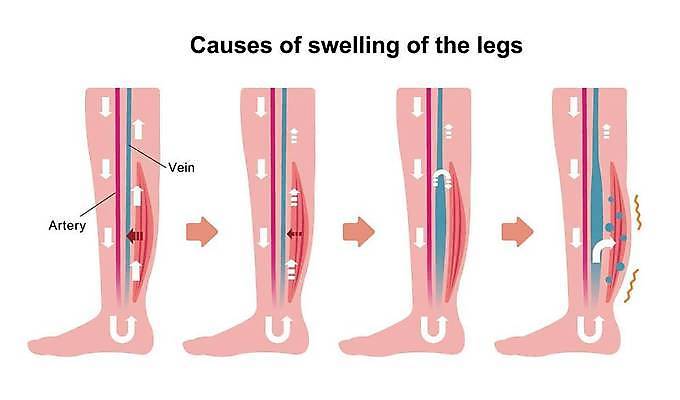 EPS 해외이미지 화살표 일러스트 의학 근육 건강 사람없음 고통 질병 동백 정맥 하지정맥류 혈관질환 해외일러스트 꽃 감정 혈관 파일형식 벡터 이미지허브