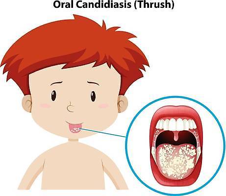 EPS 해외이미지 클립아트 어린이 백그라운드 일러스트 조류 건강 식이요법 미술 소년 그래픽 입 혀 그림 클립 감염 고립 곰팡이 면역력 이스트 해외일러스트 동물 남자 문화예술 사람 신체부위 파일형식 벡터 이미지허브