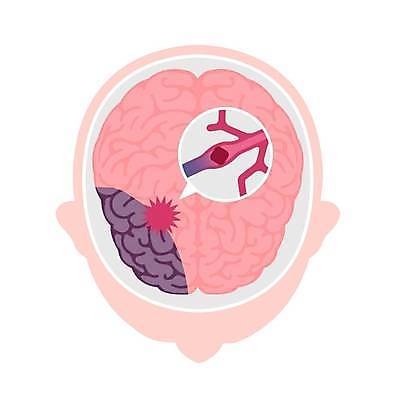 EPS 해외이미지 일러스트 의학 건강 사람없음 질병 뇌 혈관 뇌경색 뇌질환 뇌혈관 혈관질환 해외일러스트 장기_의학 파일형식 벡터 이미지허브