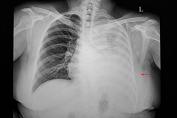 포토 JPG 해외이미지 백그라운드 신체 해부 뼈 골격 엑스레이 건강 병원 사람 사람없음 약 환자 광선 흰색 호흡기관 질병 큼 흉부 필름 궤 방사선 해외포토 컬러 의학 장기_의학 크기 파일형식 이미지허브