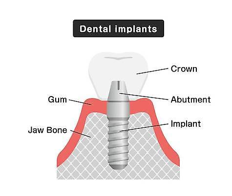 EPS 해외이미지 일러스트 부분 해부 왕관 뼈 건강 치과 병원 사람 치료 약 3D 건강관리 장비 나사 도자기 입 횡단보도 치아 만화 치과의사 외과 턱 틀니 고립 돌봄 방법 보철 복원 인공 잇몸 철강 해외일러스트 신체 의학 모션 관리 신체부위 의사 공구 소화기관 보행로 디지털합성 파일형식 벡터 이미지허브