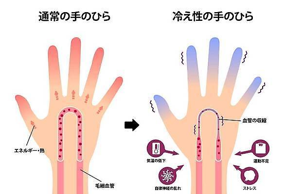 EPS 해외이미지 손 화살표 일러스트 의학 건강 신체부위 비교 차가움 질병 혈관 혈액순환 손시려운 해외일러스트 컨셉 사람 장기_의학 파일형식 벡터 이미지허브