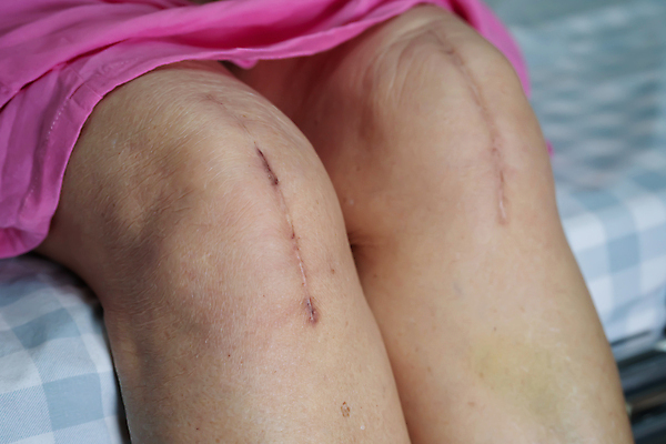 포토 JPG 해외이미지 여자 노년 신체 해부 건강 병원 사람 성인 사람없음 치료 약 금속 검은색 고통 환자 긴급 수술 닫기 질병 상처 위험 자르기 은퇴 간호 피부 관절염 땀 무릎 골다공증 섬유 외과 테라피 교체 돌봄 절개 치유 흉터 해외포토 감정 컬러 컨셉 의학 모션 재질 신체부위 뷰티 직물 파일형식 이미지허브