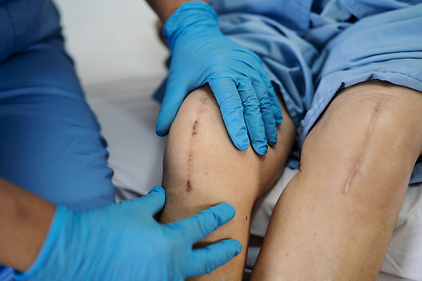 포토 JPG 해외이미지 여자 노년 신체 해부 건강 병원 사람 성인 사람없음 치료 약 금속 검은색 고통 환자 긴급 수술 닫기 질병 상처 위험 자르기 은퇴 간호 피부 관절염 땀 무릎 골다공증 섬유 외과 테라피 교체 돌봄 절개 치유 흉터 해외포토 감정 컬러 컨셉 의학 모션 재질 신체부위 뷰티 직물 파일형식 이미지허브