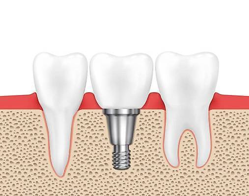 EPS 해외이미지 모양 모델 디자인 백그라운드 컨셉 일러스트 해부 뼈 건강 치과 사람 그래픽 세트 약 금속 흰색 나사 입 수술 플랫 실 치아 오브젝트 합성 윤곽 뿌리 광택 외과 틀니 순서 보철 인공 잇몸 철강 해외일러스트 컬러 신체 의학 재질 병원 신체부위 공구 소화기관 파일형식 벡터 이미지허브